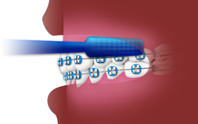 https://baselineortho.com/wp-content/uploads/2020/12/brush1.png