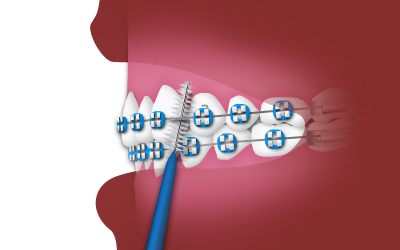 https://baselineortho.com/wp-content/uploads/2020/12/interdental.png