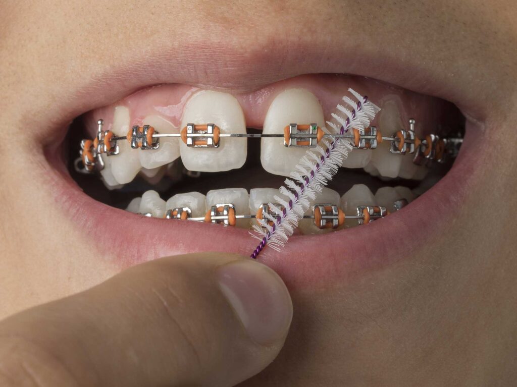 Interdental brush cleaning between braces and wires for proper orthodontic oral hygiene