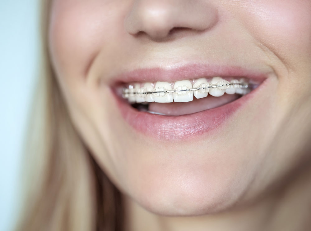 Close-up of a smiling person wearing clear ceramic braces with a thin metal wire across their teeth.