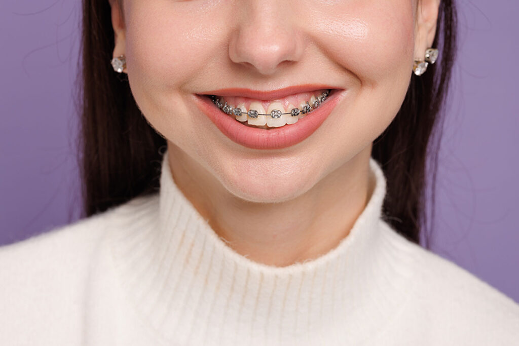 Patient smiling with braces during orthodontic treatment in Claremont, California