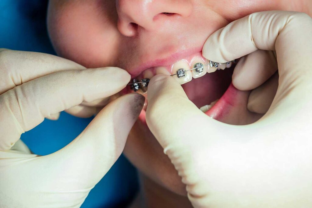 Close-up of braces being applied as part of early orthodontic care in Claremont