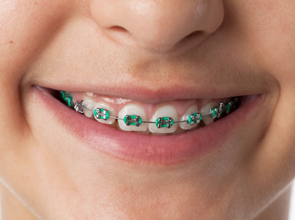 Close-up of a smiling person wearing metal braces with green elastic bands on their teeth.