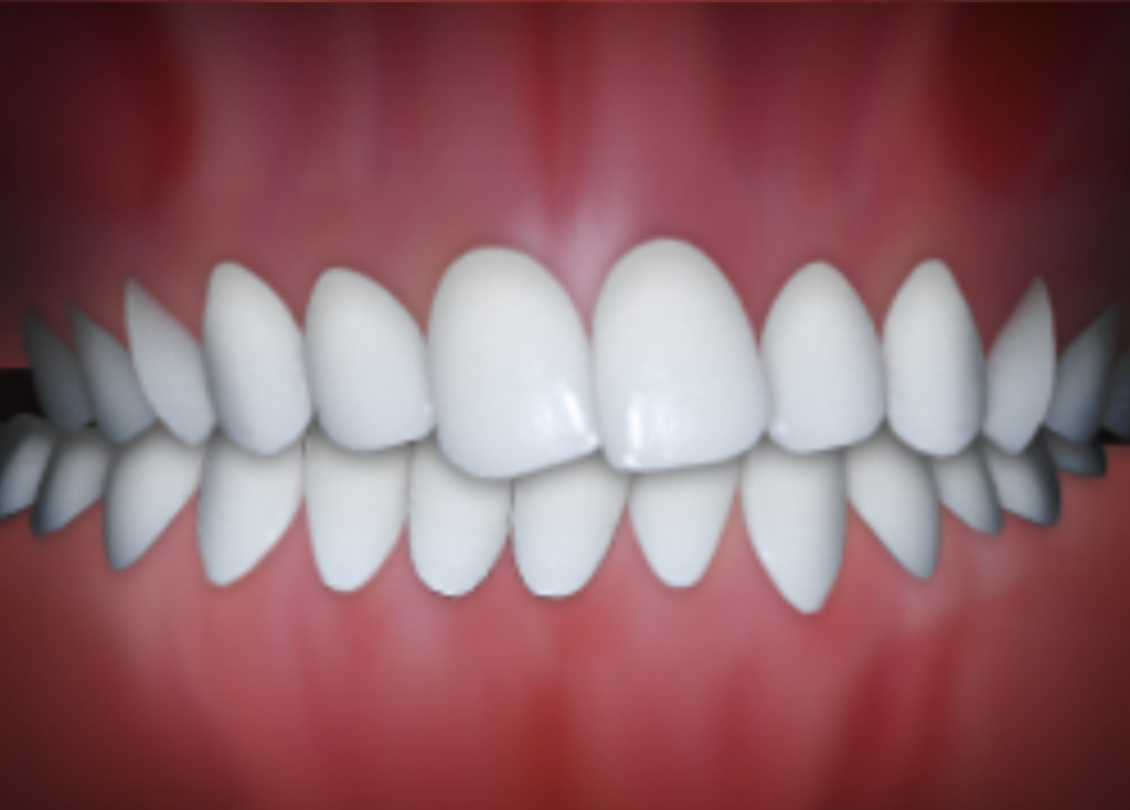 3D illustration of straight, properly aligned teeth showing an even bite and balanced smile alignment.