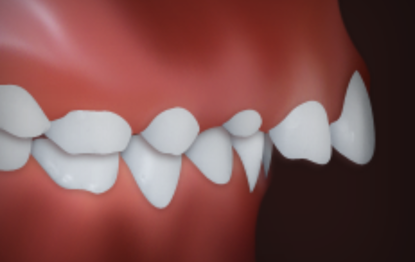 3D illustration of crowded and misaligned teeth with overlapping front teeth and crooked bite alignment.