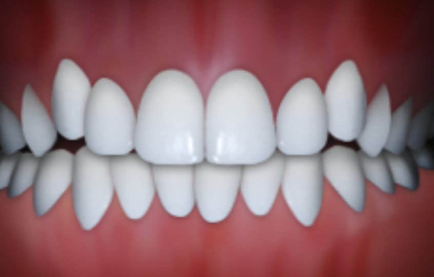 dental crowding in Claremont CA with overlapping teeth requiring orthodontic braces treatment