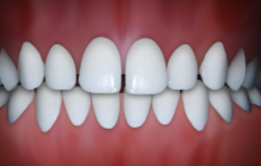 open bite orthodontic condition with gap between front teeth treated with braces in Claremont CA