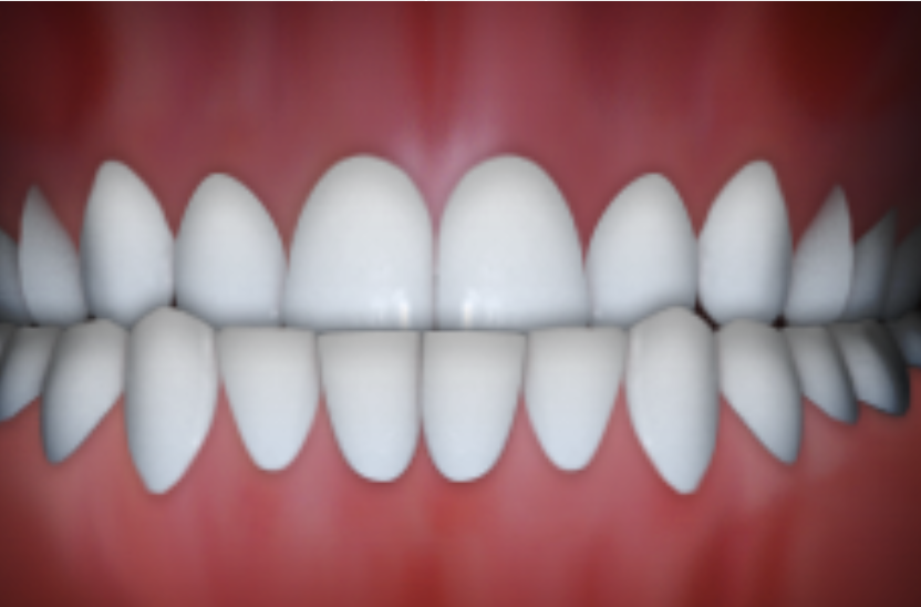 underbite showing lower teeth extending past upper teeth in orthodontic treatment in claremont ca