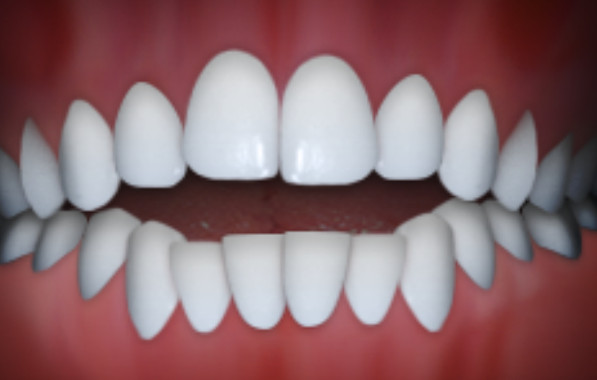 open bite orthodontic problem in Claremont CA showing teeth misalignment