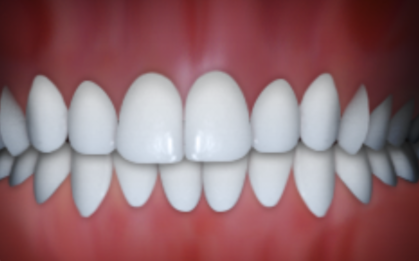 dental midline misalignment in Claremont CA orthodontic treatment
