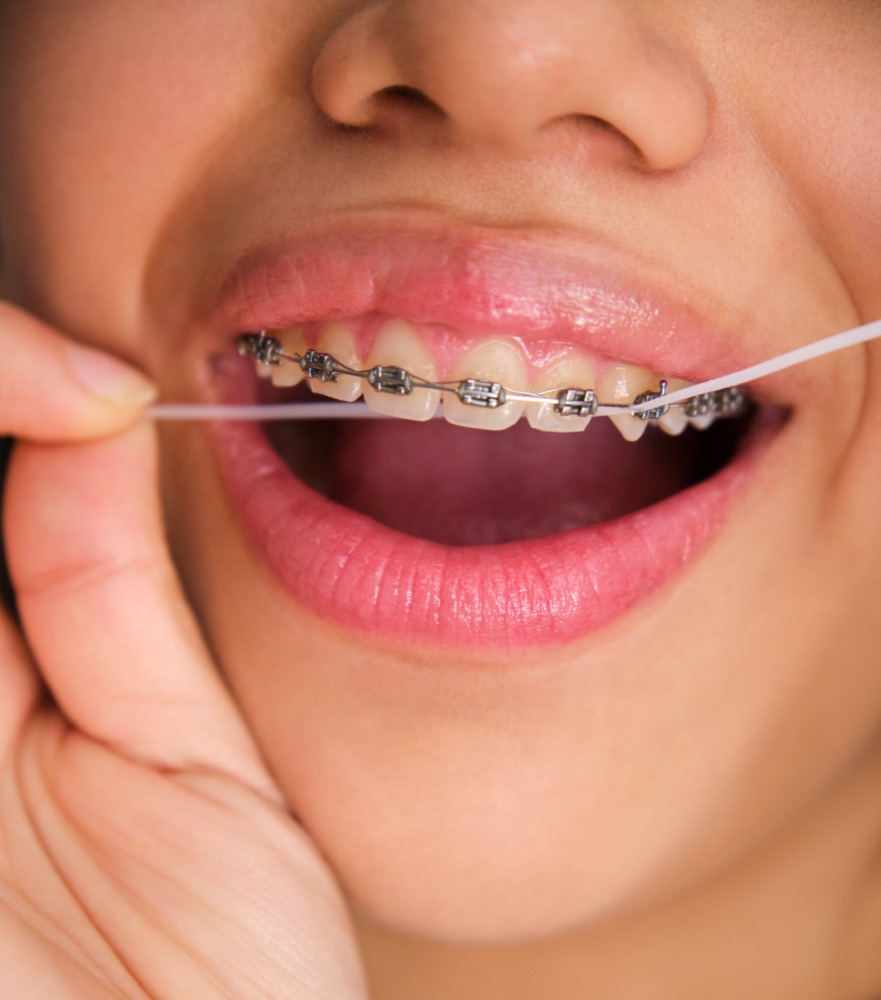 Flossing teeth with braces during orthodontic treatment in Claremont CA