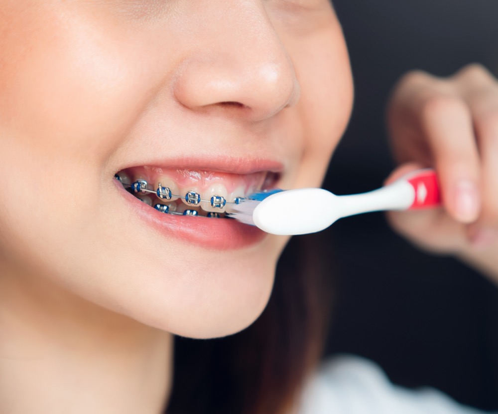 Patient brushing teeth with braces at Baseline Orthodontics in Claremont CA